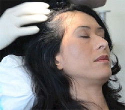 Hair Transplant Abroad - Melbourne Hairdresser 1