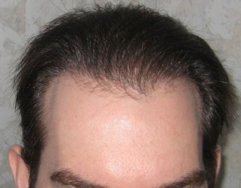 Hair Transplant Abroad - Melbourne Hairdresser 3