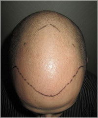 Hair Transplant Abroad - Melbourne Hairdresser 5